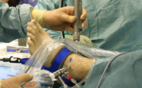 Image of an ankle arthroscopy procedure